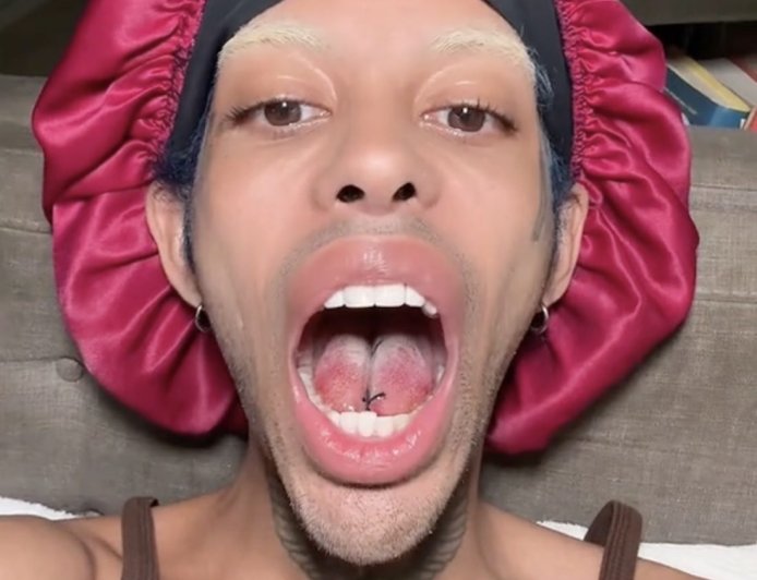 TikTok Star Shares Before and After Videos of Tongue-Splitting Surgery