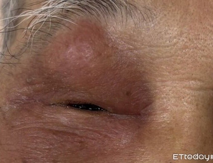 老翁眼皮腫到睜不開　醫揪出「鼻竇炎」害眼周塞滿膿瘍