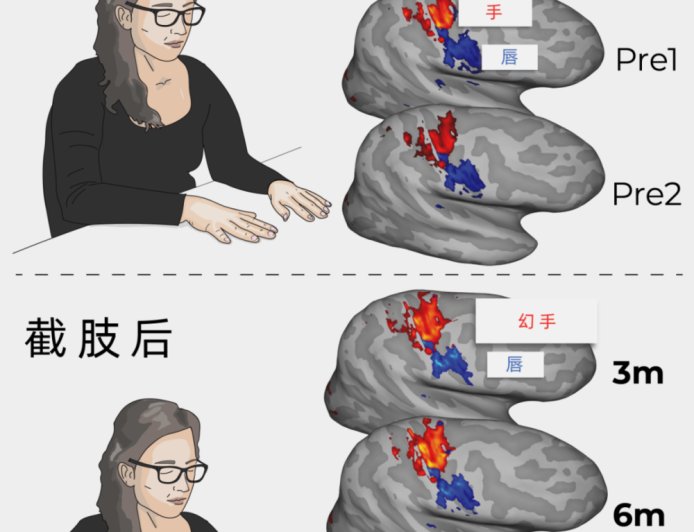 为何截肢后还会幻痛？