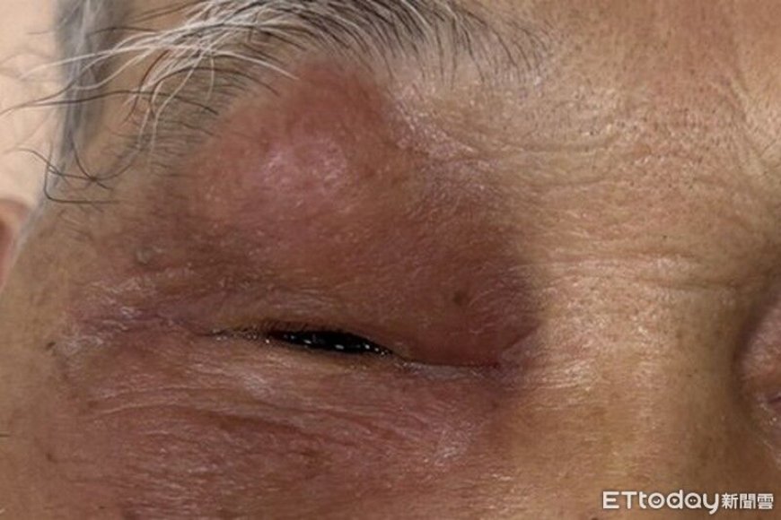 老翁眼皮腫到睜不開　醫揪出「鼻竇炎」害眼周塞滿膿瘍