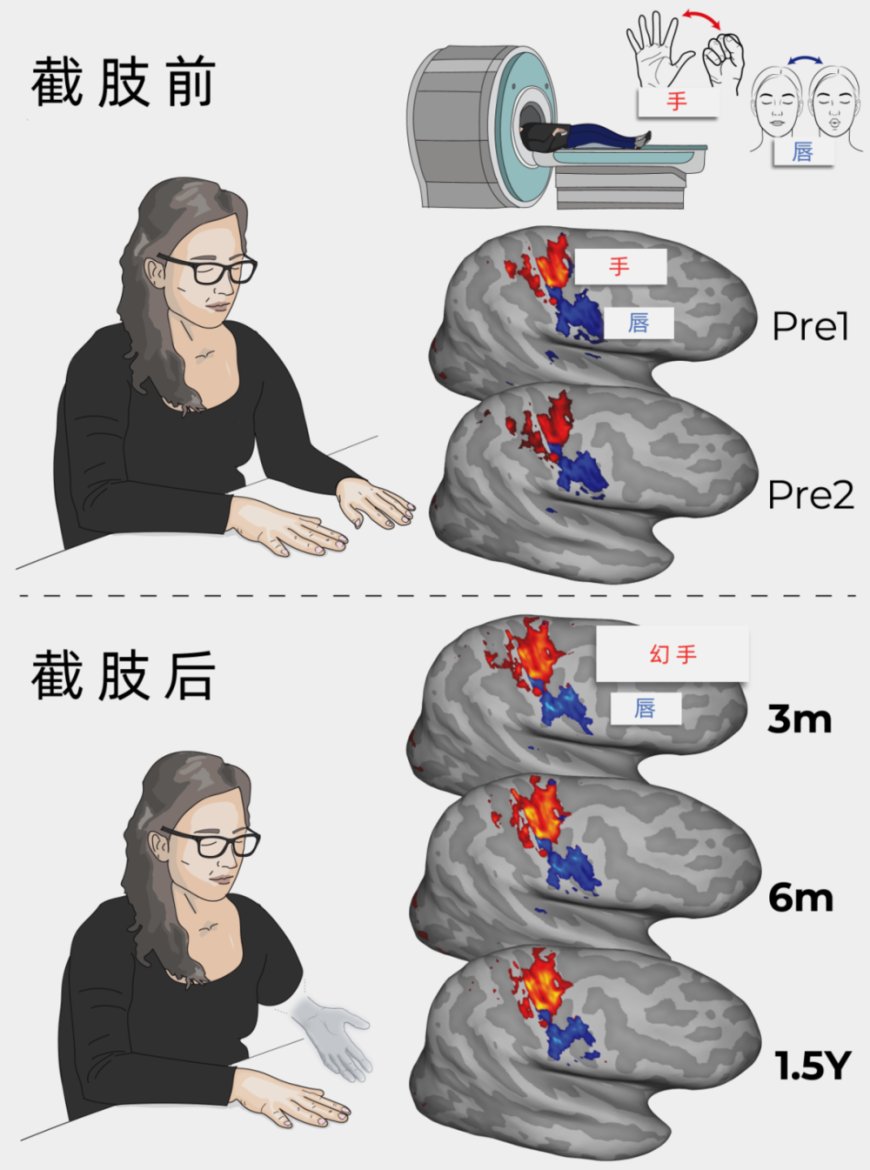 为何截肢后还会幻痛？