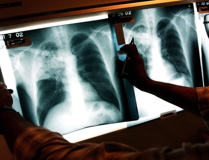 Three active tuberculosis cases reported in Maine as deadly disease continues to tick up across country