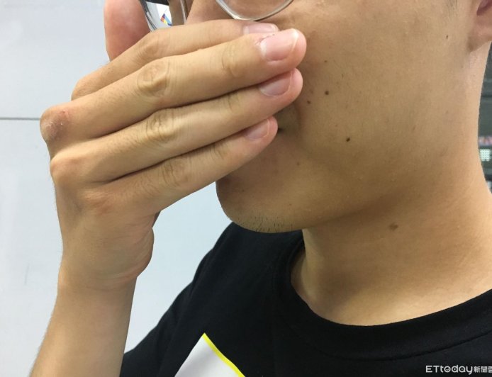 少年「每分鐘打嗝40次」痛苦休學　「浮針」7次治療奇蹟痊癒