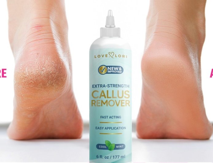This Salon-Quality Callus Remover Dissolves Thick Dead Skin — On Sale for $9
