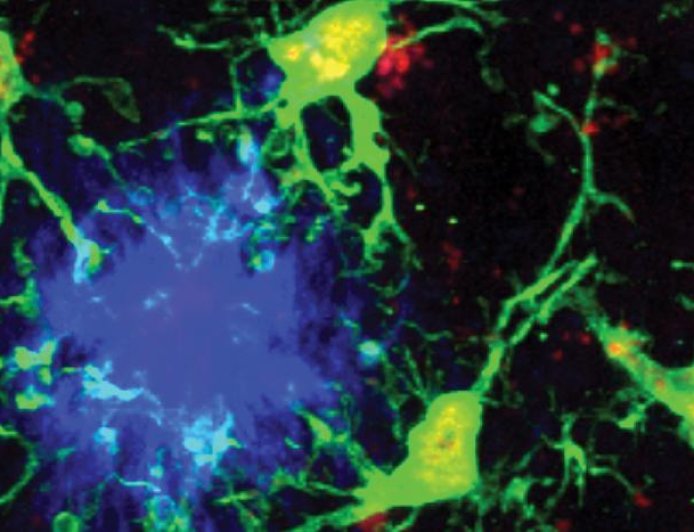 重磅：科学家找到阿尔茨海默病的“内置刹车系统”