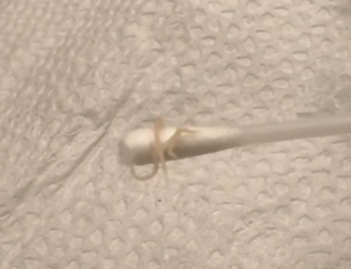 正妹媽驚見女兒屁股「爬出蟯蟲」　半夜掏出3、4隻嚇爛