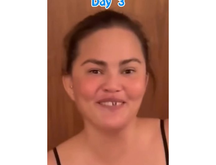 Chrissy Teigen Knocks Out Her Own Front Tooth in Candy Cane Mishap