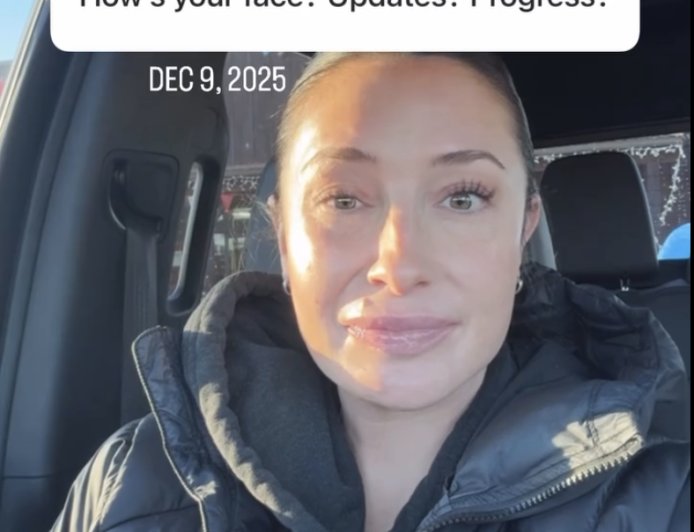 Bristol Palin Shares Update on Facial Paralysis After 1 Year