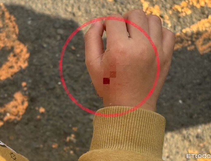 一句道歉都沒有！4歲女童遭柴犬咬傷　家屬不滿飼主冷處理提告