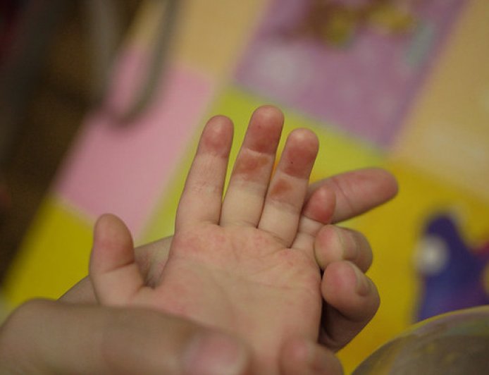 保母餵1歲半幼兒吃起司饅頭！塞「5碎塊」缺氧過久...搶救45天亡