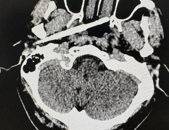 男子被一根筷子从耳部插入颅底 距动脉仅5毫米 医生成功救回