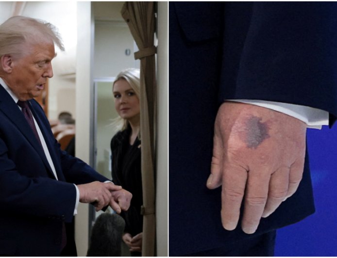 川普手背驚現「超大瘀青」！　自爆每天吞高劑量阿斯匹靈