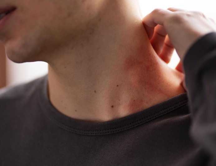 「皮蛇」不只長疹子！帶狀皰疹神經痛恐拖數年...40年老中醫：氣通就不痛